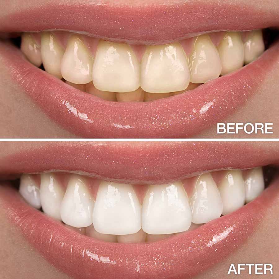 Teeth whitening in Lahore